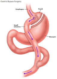 Gastric Bypass surgery $5500